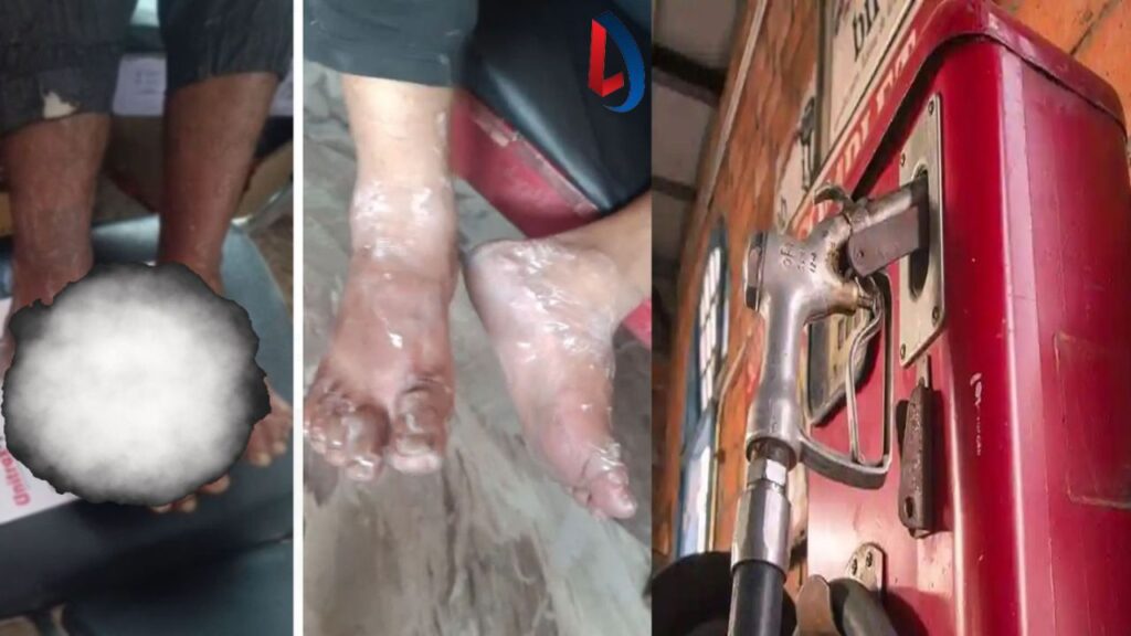 Petrol Pump की लापरवाही: गैस रिसाव की वजह से चापानल में लगी आग, तीन युवक झुलसे
