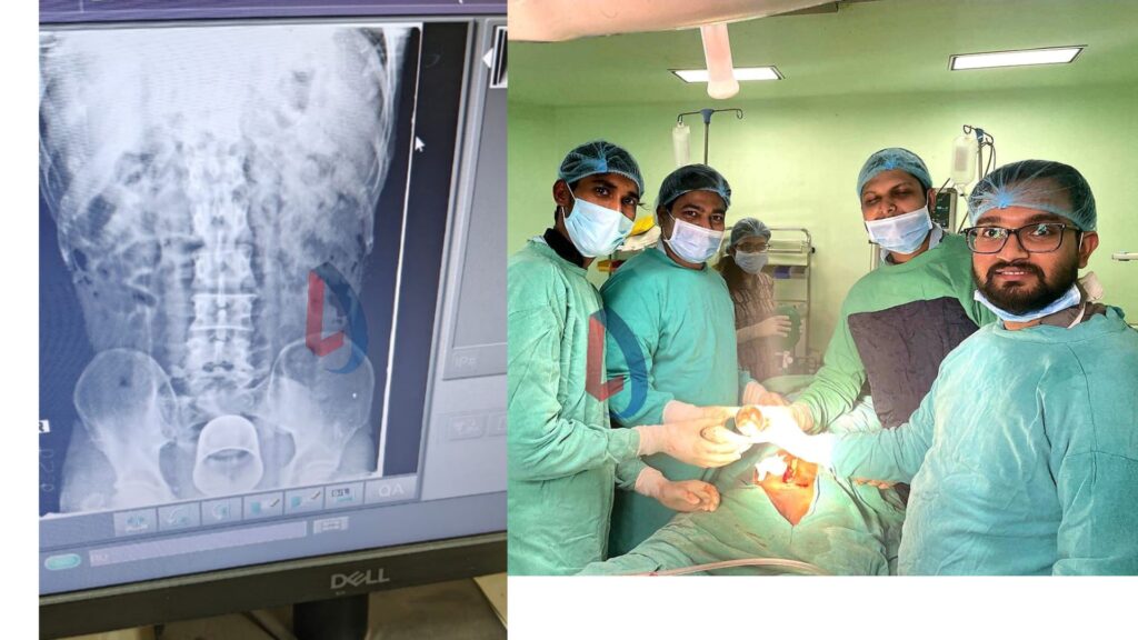 A steel glass came out of the stomach- Such a patient reached PMCH that the doctor was stunned to see him