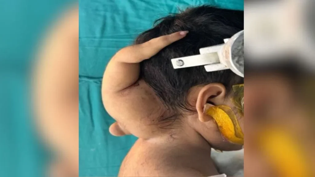 bhopal-baby-news