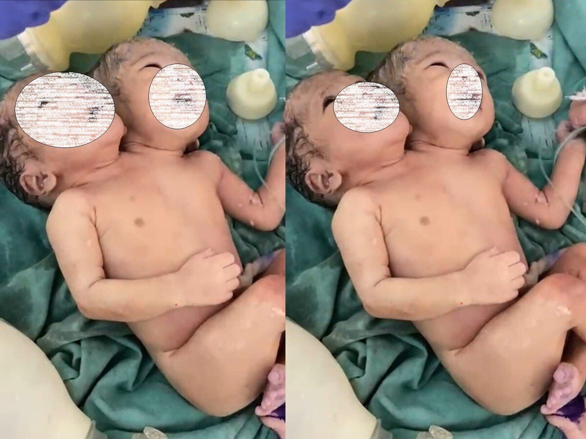 twins_born_in_indore