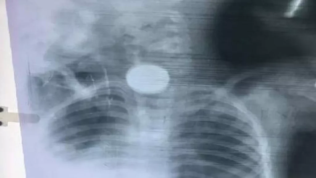 coin-in-child neck