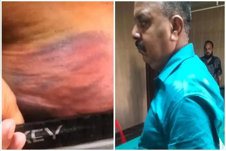 पलामू में DSP पर बेरहमी से पिटाई का आरोप, मेडिकल रिपोर्ट में गंभीर चोट लगने की पुष्टि